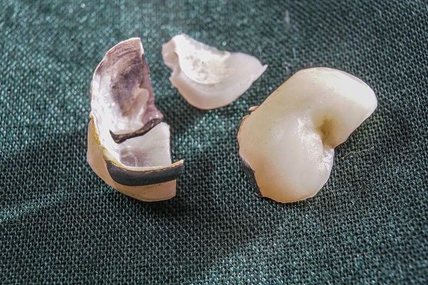 Can A Dental Crown Break?