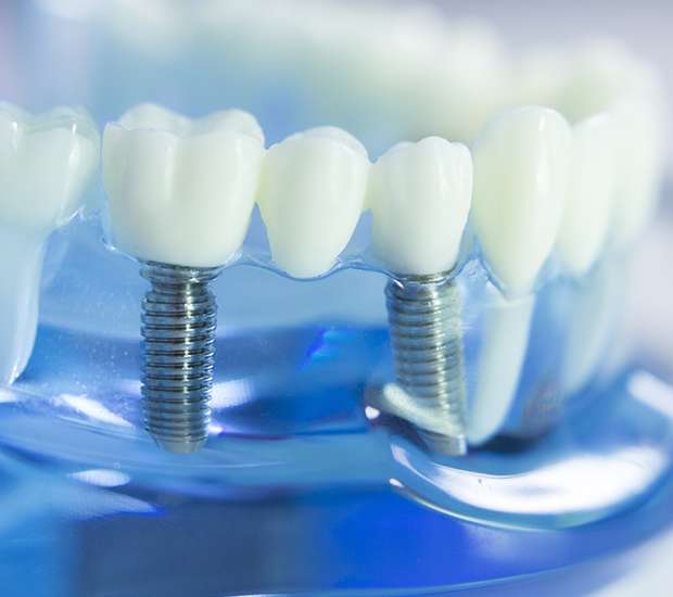 Hollis Dental Implants