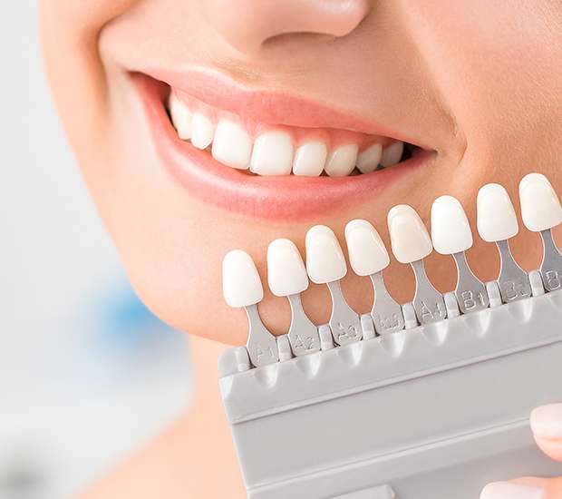 Hollis Dental Veneers and Dental Laminates